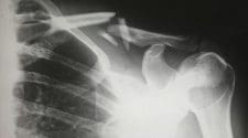 In navigating the path from injury to riding again, it's evident that recovery is not a linear journey but a multifaceted process that demands attention to the physical, psychological, and social dimensions of healing. 