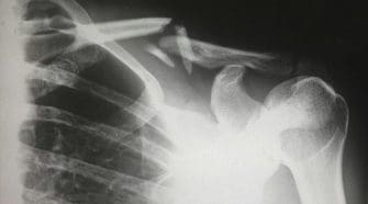 In navigating the path from injury to riding again, it's evident that recovery is not a linear journey but a multifaceted process that demands attention to the physical, psychological, and social dimensions of healing. 